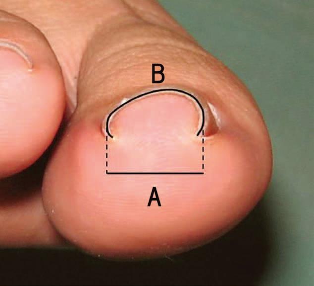 CURVATURE INDEX A=Apparent width of the nail tip B= Traced length of nail tip B/A= curvature