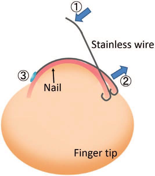 CONSERVATIVE THERAPIES Trimming/Debridement Nail steel or plastic bracing (Sogawa method) Nail taping, nail splinting Keryflex