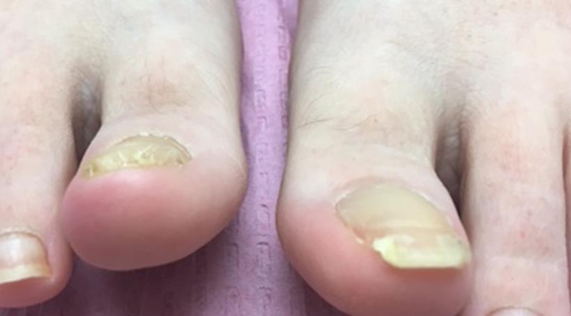 DISAPPEARING NAIL BED Coined in 2005 by Dr Daniel (Cutis 2005;76:325 327) A shortened or narrowed nail bed that is the result of long standing onycholysis 20% shorter than the bilateral