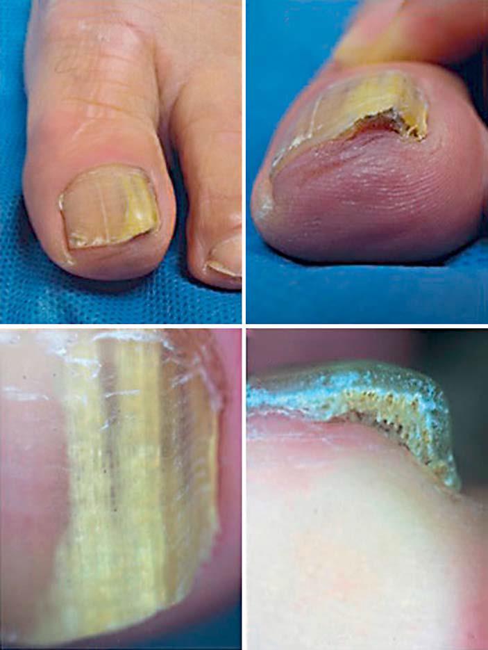 Yellow discoloration, splinter hemorrhages, nail plate