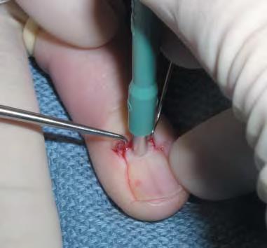 Proximal vs distal matrix Nail bed punch good for inflammatory, infectious,