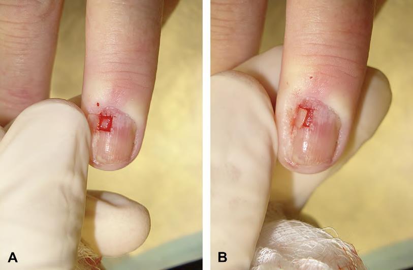 ALTERNATIVES TO TOTAL NAIL AVULSION: WINDOW Confined portion of nail bed Foreign body,