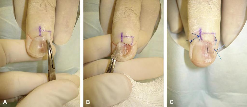 ALTERNATIVES : LATERAL NAIL PLATE CURL Reflection of proximal nail fold for issues with matrix and eponychium