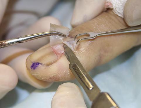 FOLLOWING AVULSION: MATRIX SHAVE BIOPSY JAAD 2007; 56:803-10 LM in proximal or
