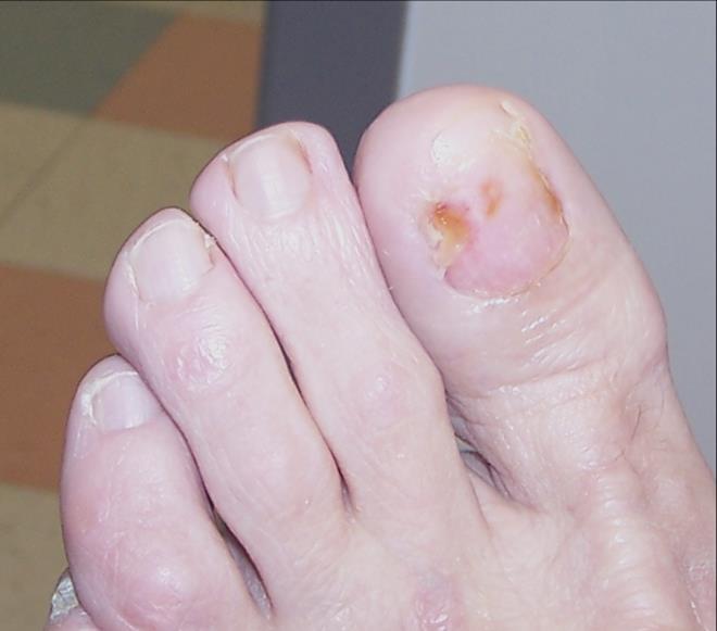 COMPLICATIONS Nail dystrophy Bleeding Post