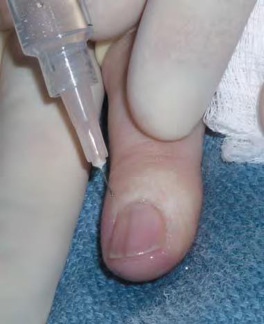 A TOURNIQUET OF FLUID The Foot and Ankle Online