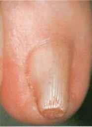 Great toenail Enlarged base of distal phalanx Traction osteophytes Hereditary vs
