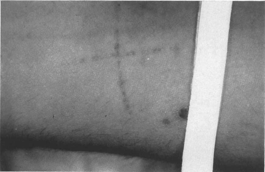 or less evenly dilated capillaries, while the psoriatic patient, even after this short period, shows capillaries grouped in an oval pattern with the increase of tortuosity leading to