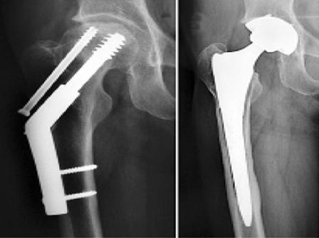 Intertrochanteric fractures Fig.1: Postoperative X-ray of endoprosthetic replacement of patients with failed treatment of intertrochanteric hip fractures. ed.