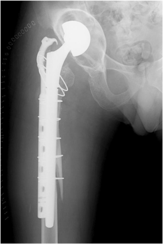 The diagnosis was Vancouver type B2 peri-prosthetic fracture of the femur.