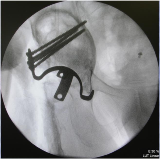 We developed the acetabulum and placed two alloimplants of femoral head bone into the weight-bearing region of the acetabular roof using an impaction bone graft method.