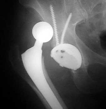 Total hip replacement Not a