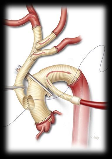 Aortic Arch/ Thoracoabdominal Aortic
