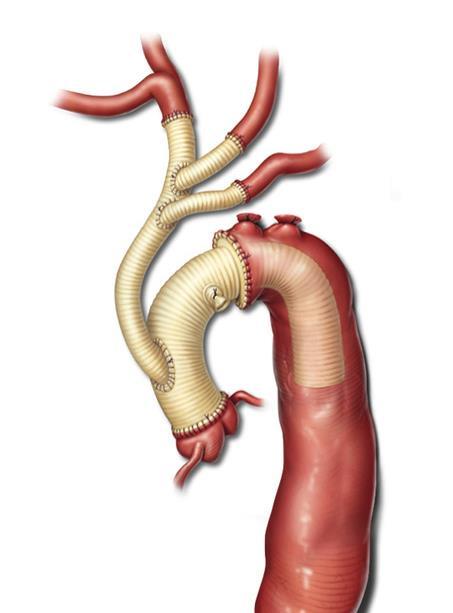 Evolution of Open Aortic Arch Femoral cannulation