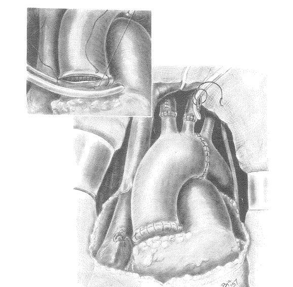 Aortic Arch Replacement First successful