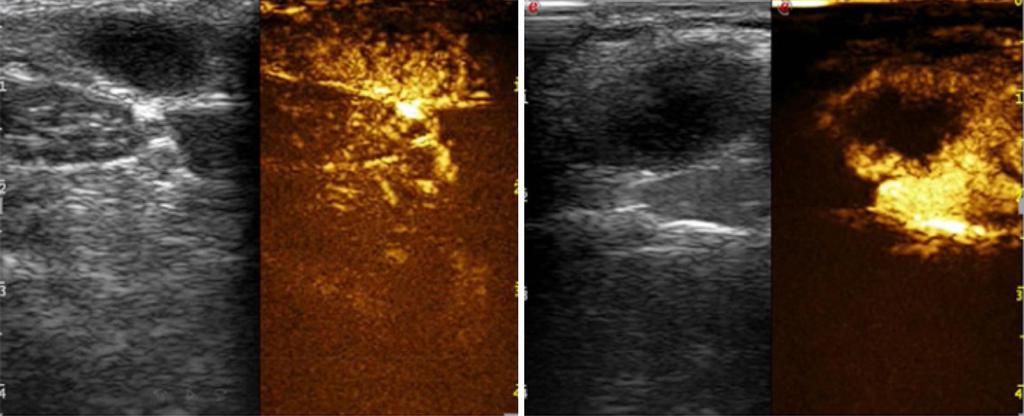 4796 Zhang et al. New indication for lymph node puncture biopsy A B Figure 3 Above shows comparison of two different enhancement patterns in lymphadenitis.