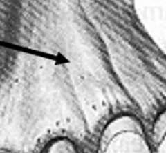 Maxillary tuberosity: it forms the termination of the residual ridge posterior extending distally from the area of the second molar to hamular