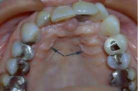 Rugae area: irregular shape of firm fibrous tissue forming the anterior portion of the midline of the palatal suture & the crust of the ridge, the anterior on the half of the palate form the fatty