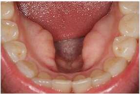 Mandibular Torri: it occurs in (6-8%) in population in 80% of the cases they are bilateral in position.