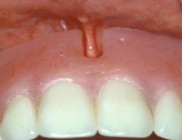 The anatomy of the edentulous ridge in the maxilla and mandible is very important for the design of a complete denture.