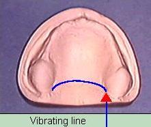 pterygomandibular raphe is pulled forward, if denture base