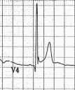 procainamide! 7 Early Repolarization T wave starts early (during ST segment) giving impression of ST elevation Most common in younger males? Associated with idiopathic v.fib.
