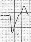 repolarization Then: deeper, wider QRS Finally: Sine-wave Very specific Treatment: