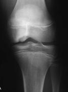 be considered (femoral or pelvic osteotomy) Long term