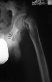 Unstable - patient presents with severe hip