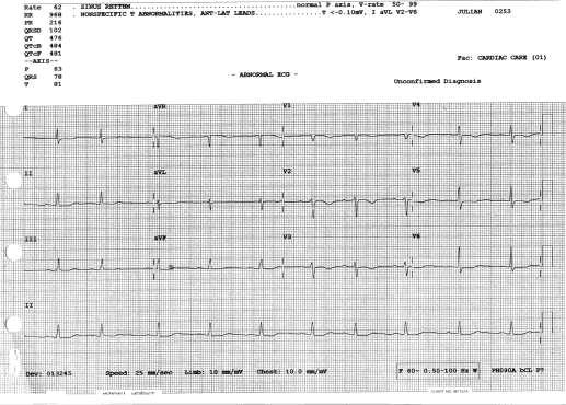 QT Interval Monitoring Case Example Patient admitted for syncope after having motor vehicle crash while driving.