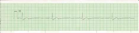 (wide QRS) or by pacemaker coming from His