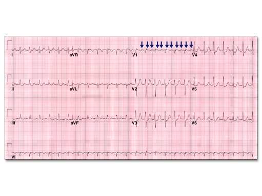 91 The Lewis Lead When P waves are not clearly seen in a rhythm strip (see lead 3 above), the Lewis lead can be very helpful in assessing for the presence of