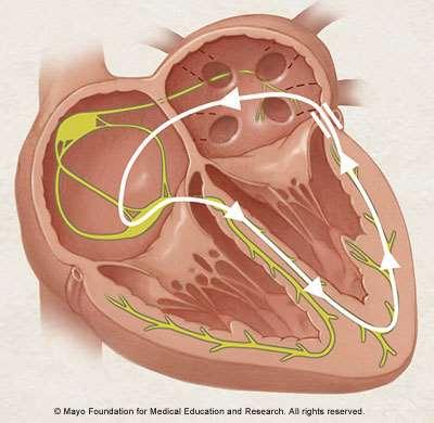 119 Orthodromic Tachycardia