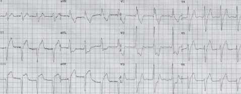Inferior Extreme STEMI on Axis Arrival or V6 to Negative CCU Vital Signs Stable 12 lead ECG