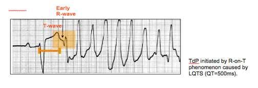 191 QT Interval Measured from beginning of QRS complex to the end of the T wave Reflects both ventricular