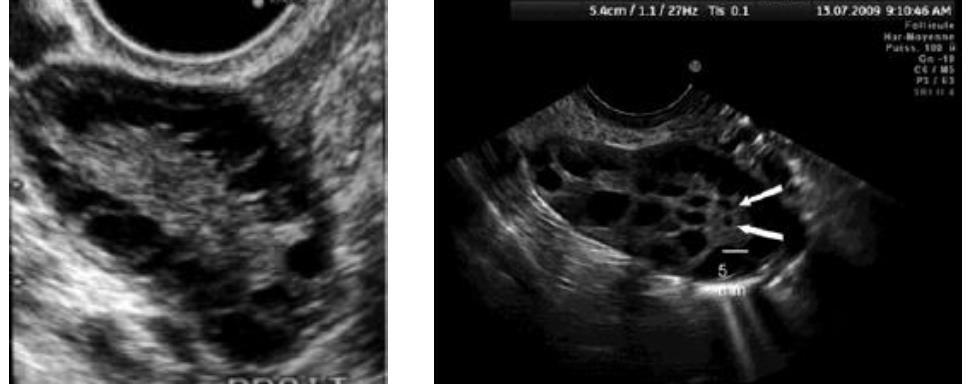 Diagnosis of Polycystic Ovarian Morphology Use transvaginal ultrasound Follicle number per ovary 18 and/or ovarian volume 10ml if using new technology