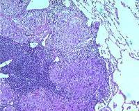 Courtesy of Sat Sharma, MD,  Series of histologic slides (see the previous 2 images) from a patient with sarcoidosis show characteristic noncaseating granulomas with many giant cells.