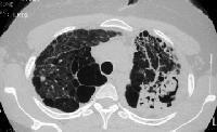 Left paratracheal and aortopulmonary window lymph nodes are less frequently involved, but they may be difficult to detect on a standard PA chest radiograph.
