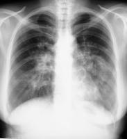 Sarcoidosis, thoracic. Posteroanterior chest radiograph shows enlarged calcified hilar lymph nodes with calcifications.