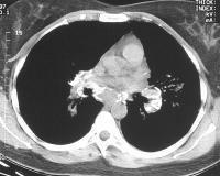 Axial CT scan through the mediastinum in the same patient as in the previous image shows extensive calcifications in the mediastinal and