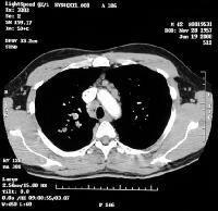 Posteroanterior chest radiograph shows extensive lung parenchymal involvement. At this stage, the patient had moderate-effort dyspnea.