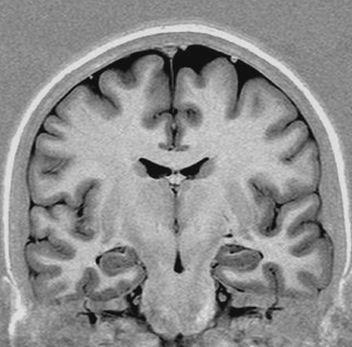 Chapter 6 Links: Afbeelding met MRI van de hersenen bij een gezond persoon, van voren gezien.