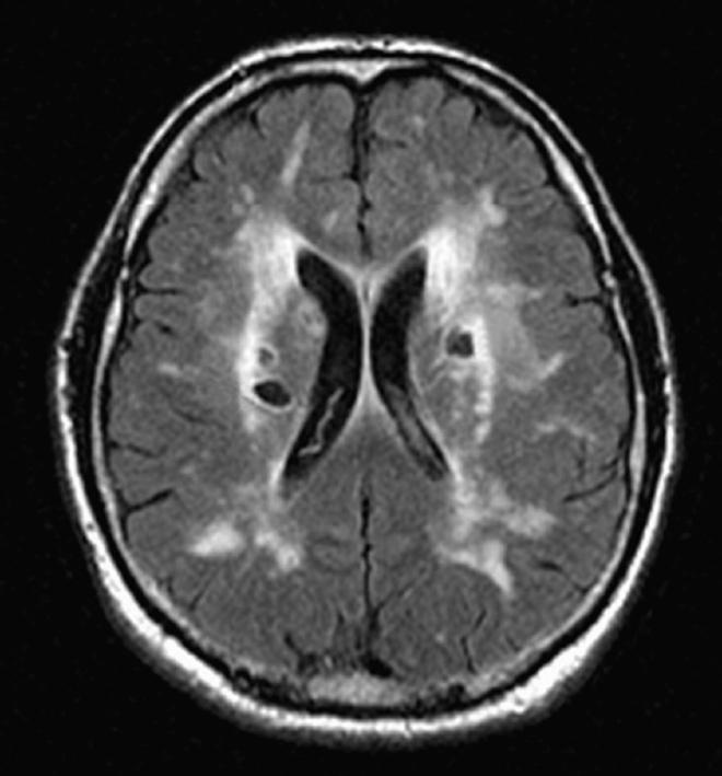 Rechts: Afbeelding met MRI van de hersenen bij een patiënt met uitgebreide witte stofafwijkingen en lacunaire infarcten (pijlen), van boven gezien.