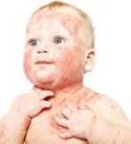 Objectives Recognize the clinical presentation of atopic dermatitis in infancy, childhood, and adolescence Grade atopic dermatitis as