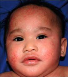 Atopic dermatitis - Epidemiology Prevalence is increasing ~15-29% Associated with loss of function mutations in Filaggrin (FLG) gene Increase expression of IL-4,