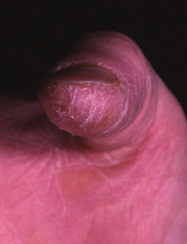 Examples of inside or endogenous rashes are atopic eczema or drug rashes, whereas fungal infection or contact dermatitis are outside or exogenous rashes.