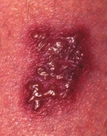 Examples of changes in the deeper tissues include erythema (dilated blood vessels, or inflammation), induration (an infiltrated firm area under the skin surface), ulceration (that involves surface