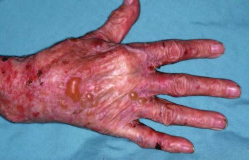 The margin or border of some lesions is very well defined, as in psoriasis or lichen planus, but in eczema it is ill-defined and merges into normal skin.