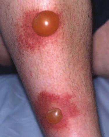 Chronic inflammatory cell infiltrates occur in conditions such as lichen planus and lupus erythematosus.