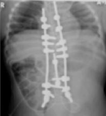 NEURAXIAL ANESTHESIA IN PATIENTS WITH SCOLIOSIS Patients with scoliosis are likely to benefit from neuraxial analgesia during labor as it provides an anesthetic option if an operative delivery is